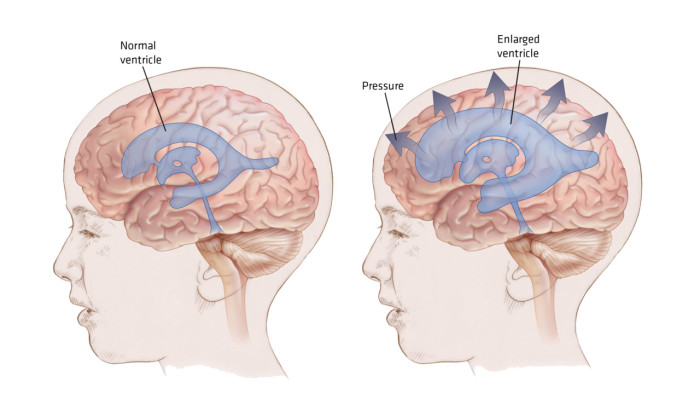 Hydrocephalus